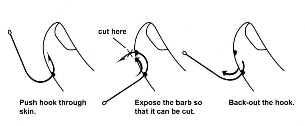 Fishing Hook Removal Steps - Cut the Barb